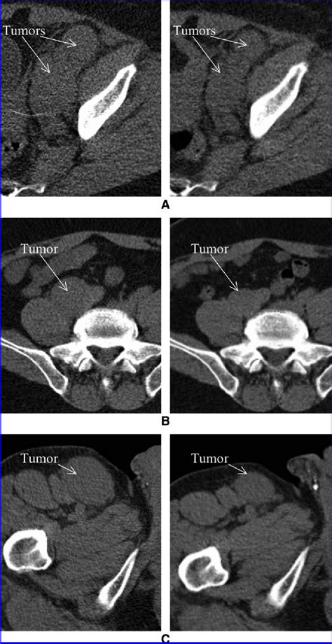 Figure 2 From Use Of Integrated Spectct Imaging For Tumor Dosimetry In