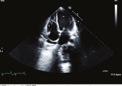 Echocardiogram Showing Severely Dilated Left Ventricle Download