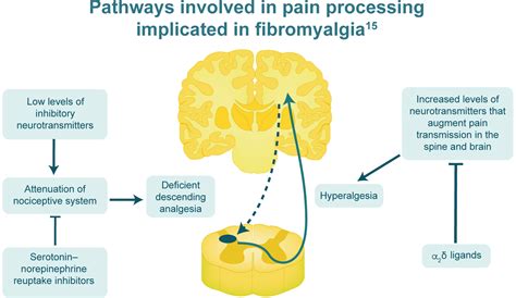 Fibromyalgia