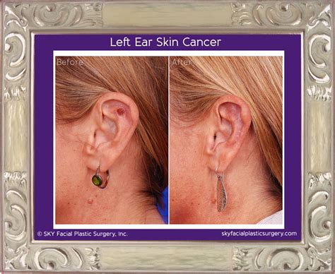 Mohs Reconstruction In San Diego After Skin Cancer — Sky Facial Plastic