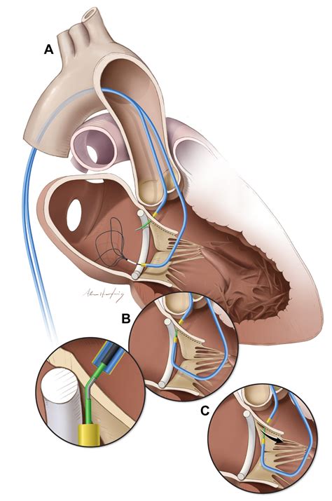 Novel Technique Reduces Obstruction Risk In Heart Valve Replacement