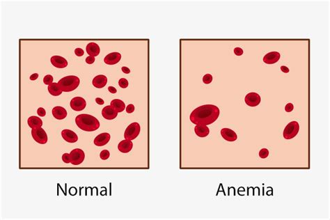 How to Tell if You Have Anemia? How to Treat It?