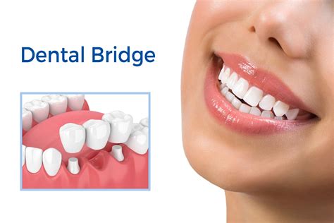 Reasons Why Dental Implant Bridges Are Better Than Dentures Aesthetix