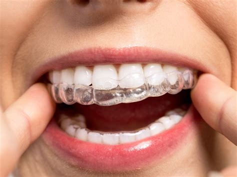 How Are Invisalign Attachments Removed