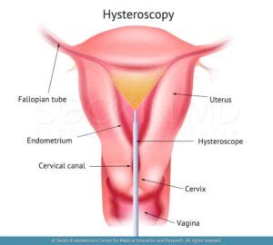 Hysteroscopy Procedure Uses And Recovery Time