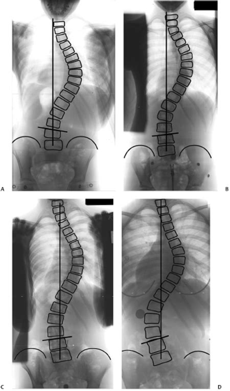 17 Surgical Treatment of the Right Thoracic Curve Pattern | Neupsy Key