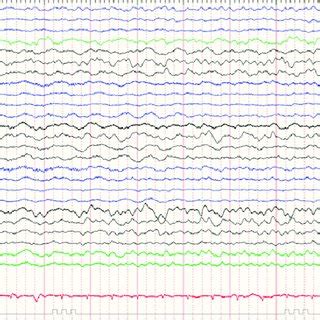 Repeat Long Term Video Electroencephalogram Recording After Eight Weeks