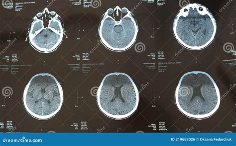 MRI of the brain in stroke stock photo. Image of brain - 219669026