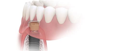 Dental Education At Ds Academy Discover All Courses Dentsply Sirona