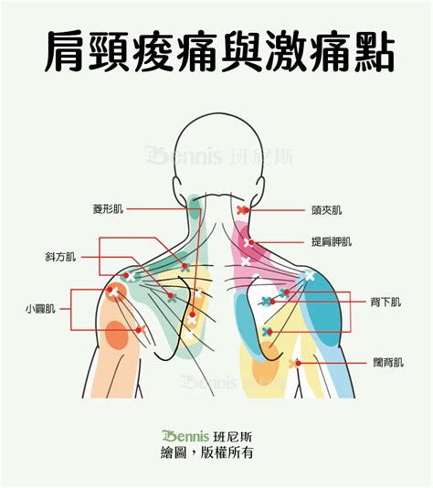 肩頸痠痛原因急性痠痛舒緩3招7個生活習慣改變更有效 班尼斯睡眠健康家