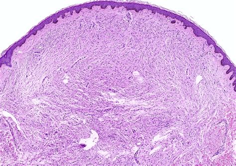 Traumatic Neuroma Pathology Outlines