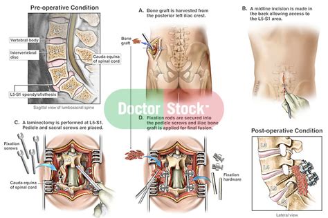 L5 S1 Spondylolisthesis With Surgical Fusion Doctor Stock