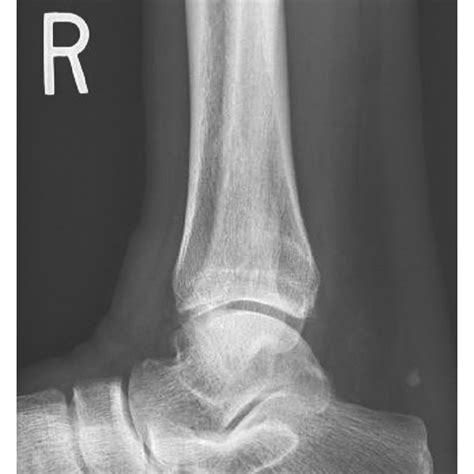 Plain Radiographs A Lateral View B Anteroposterior View And C