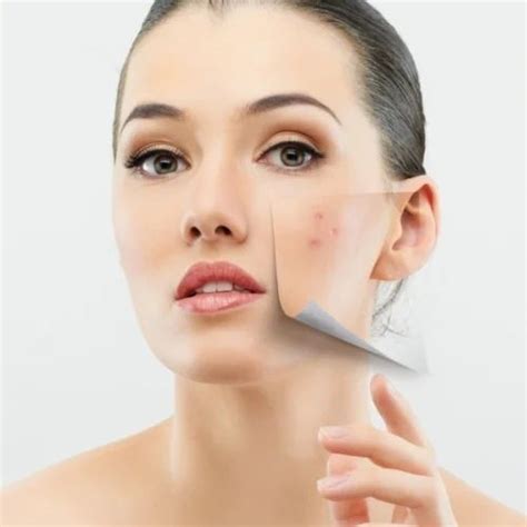 Pimple Treatment at Rs 2500/each treatment | पिमल्स ट्रीटमेंट, पिम्पल ट्रीटमेंट, मुंहासाे का ...