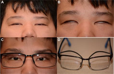 Ptosis Crutches An Eye Opening Solution Ophthalmology