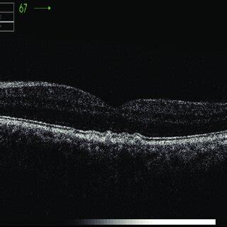 Optical Coherence Tomography Showing Multiple Subfoveal Drusen