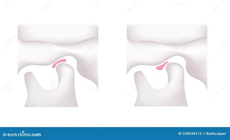 Illustration Comparing The Shapes Of The Articular Disk Normal Jaw And