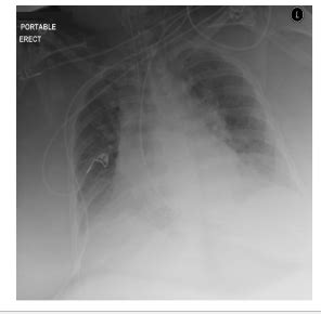 Obesity Hypoventilation Syndrome And Obstructive Sleep Apnea Flashcards