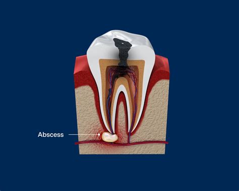 Dental Abscess Symptoms Types And Treatments Aspen Dental