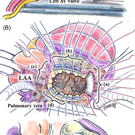 A A Transseptal Approach Through Right Atriotomy B A