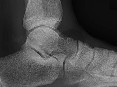 Figure Osteoid Osteoma Image Courtesy S Bhimji Md Statpearls