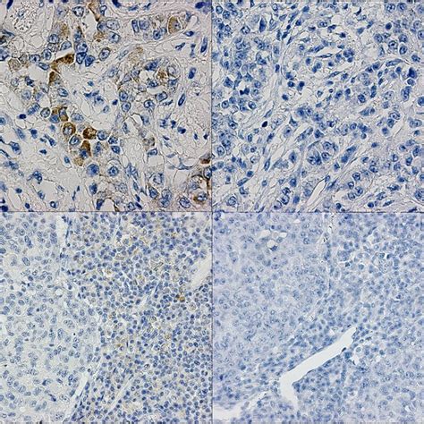 Her2 Immunohistochemistry Ihc By The Oracle Her2 Bond Ihc Detection Download Scientific