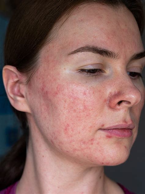 Rosacea Treatment