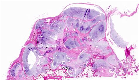 Chondroblastoma Pathology Outlines