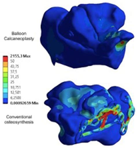 Percutaneous balloon calcaneoplasty versus open reduction and internal