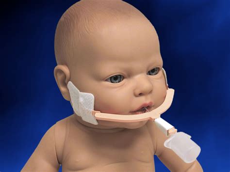 Endotracheal Intubation In Neonates