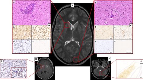 Comparison Of Histopathology With Magnetic Resonance Imaging Mri