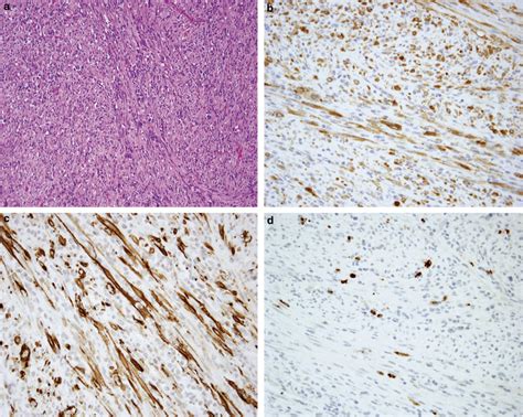 Inflammatory Myofibroblastic Tumor Showing Intersecting Fascicles Of