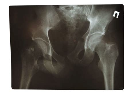 Sacral Fracture - El Paso, TX | Sciatica Pain and Treatment Clinic