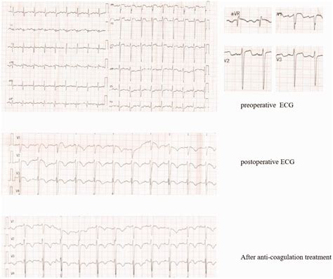 Acute Pulmonary Embolism Presenting With Electrocardiographic Signs And