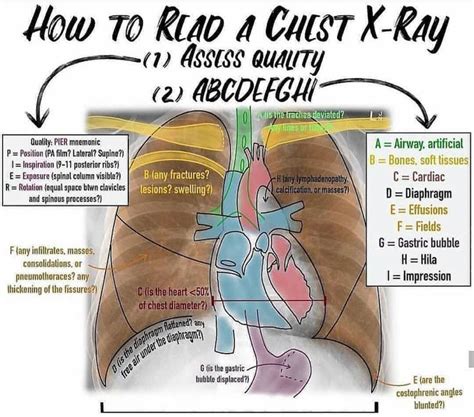 How To Read A Chest Xray Medizzy