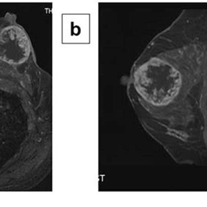 Magnetic Resonance Imaging Findings Contrast Enhanced Magnetic