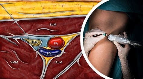 Saphenous Nerve Block At The Adductor Canal