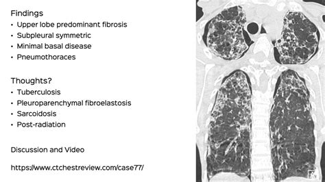 Case Bilateral Upper Lobe Fibrosis And Pneumothoraces