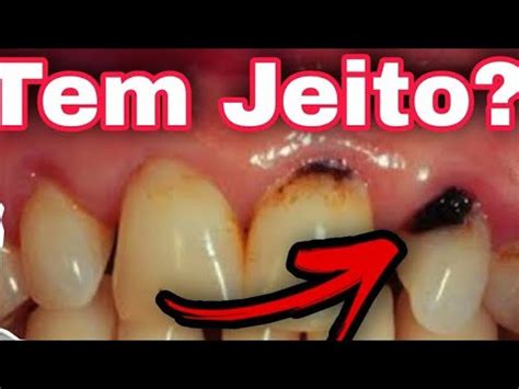 CÁRIE PERTO DA GENGIVA ou na RAÍZ do DENTE O que fazer YouTube