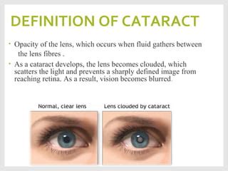 Cataract | PPT