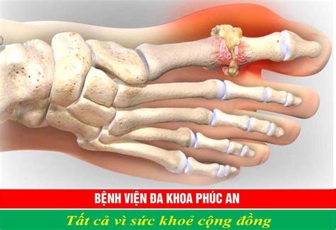 Các bệnh cơ xương khớp thường gặp Bệnh Viện Đa Khoa Phúc An