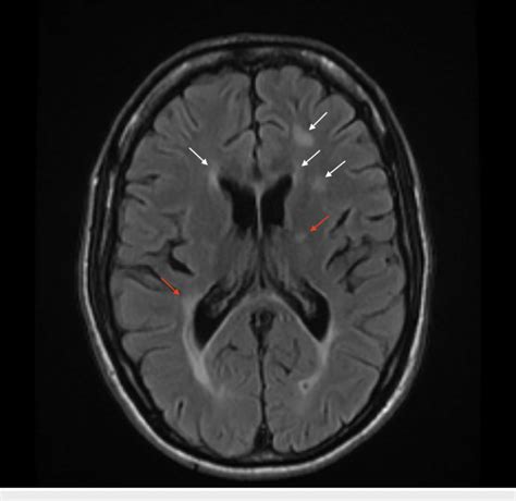 Axial T Flair Magnetic Resonance Imaging Mri Of The Brain Revealing