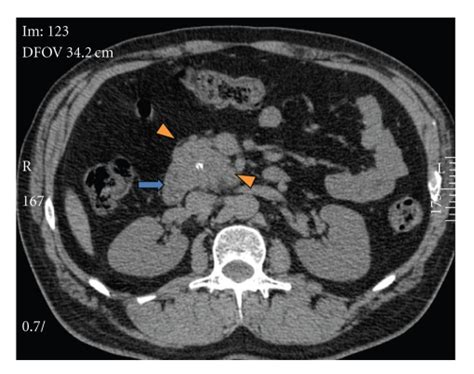 Axial Noncontrast Ct Abdomen Demonstrates A Retroperitoneal Soft Tissue Download Scientific