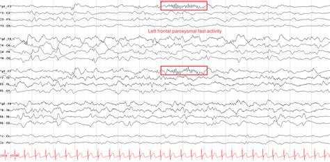 Epileptiform Activity On Eeg