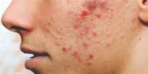 Is That A Boil Or A Pimple? Learn How To Identify Them | OnlyMyHealth