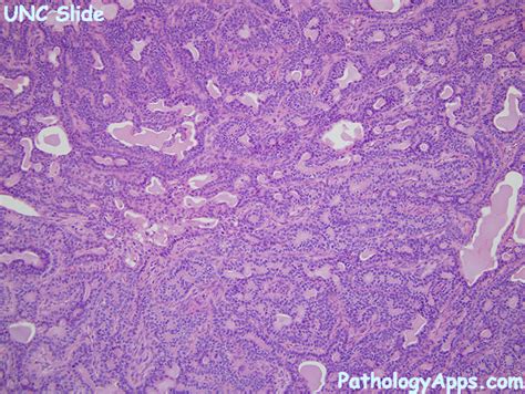 Basal Cell Adenoma Pathology