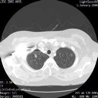 Lung Segmentation Instance Segmentation Dataset And Pre Trained Model