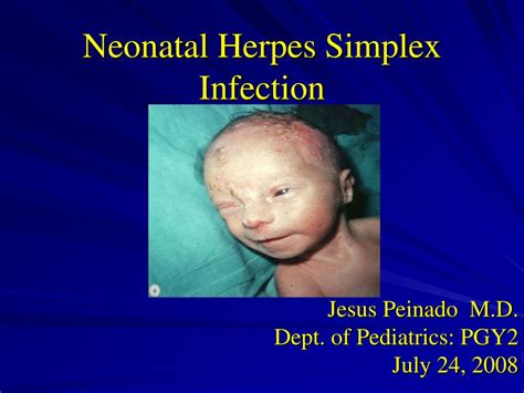 Ppt Neonatal Herpes Simplex Infection Powerpoint Presentation Free