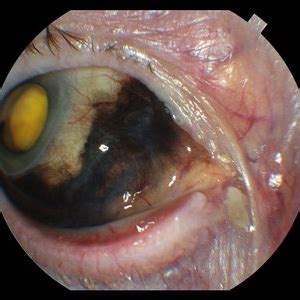 Extrascleral Extension Of Choroidal Melanoma Retina Image Bank