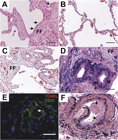 Vascular Remodeling In Usual Interstitial Pneumonia Uip A Shows Uip